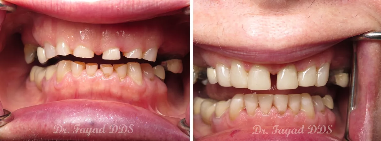 Dental before and after photo