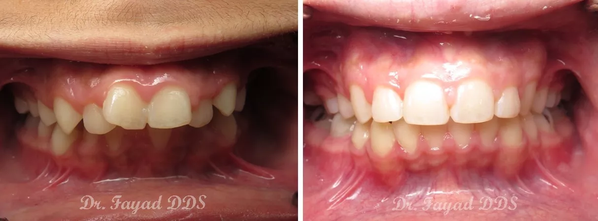 Dental before and after photo