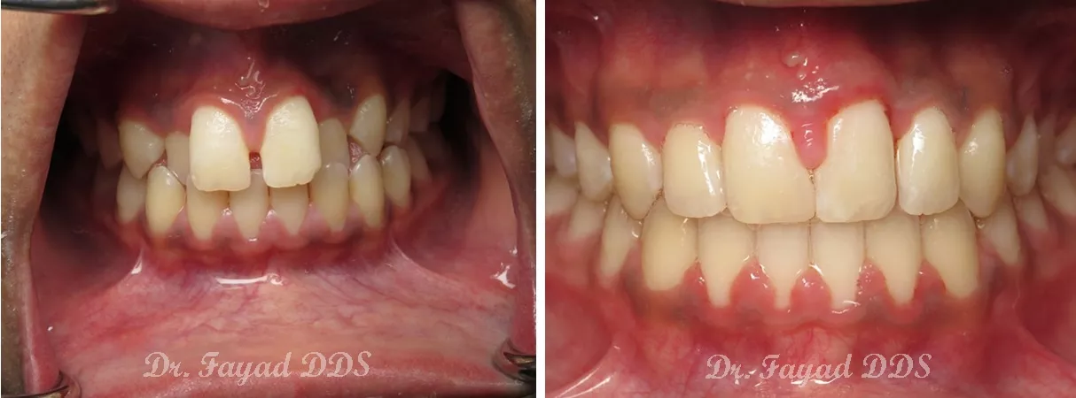 Dental before and after photo