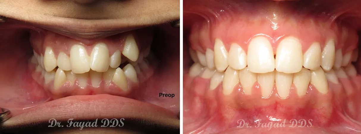 Dental before and after photo