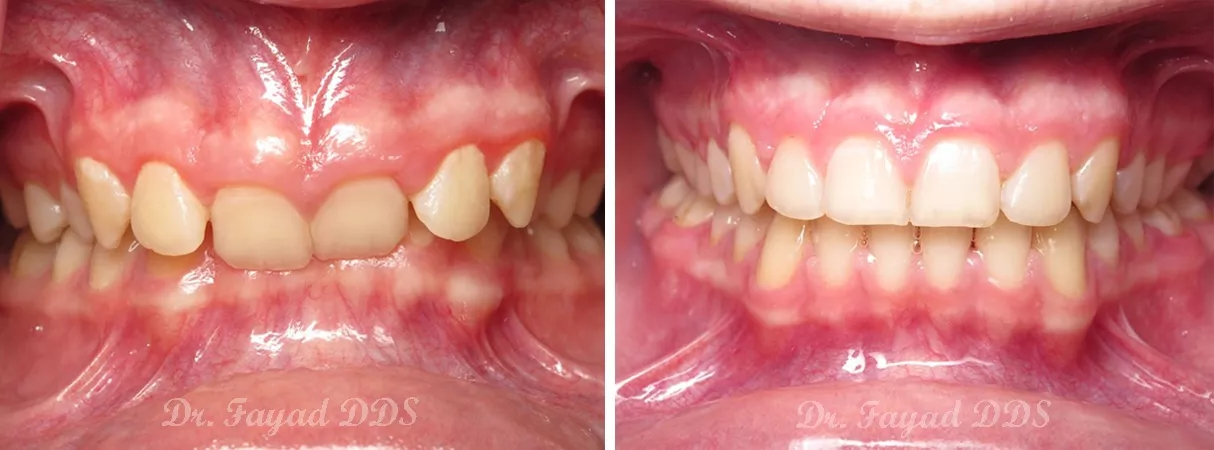 Dental before and after photo