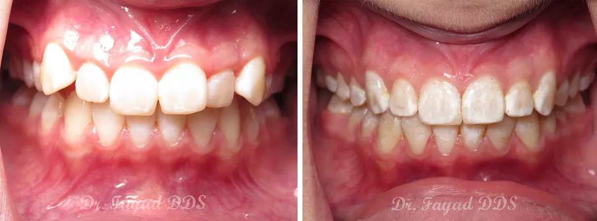 Dental before and after photo