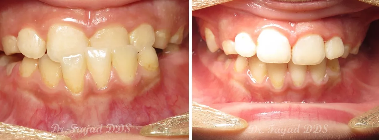 Dental before and after photo