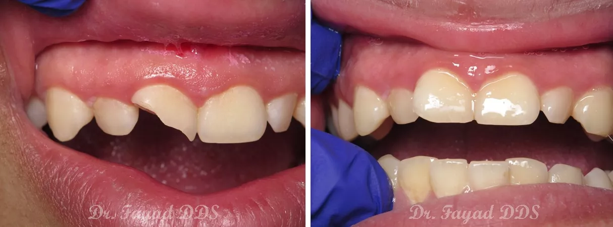 Dental before and after photo