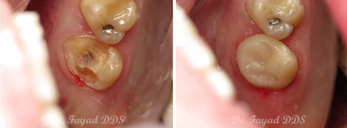 Dental before and after photo