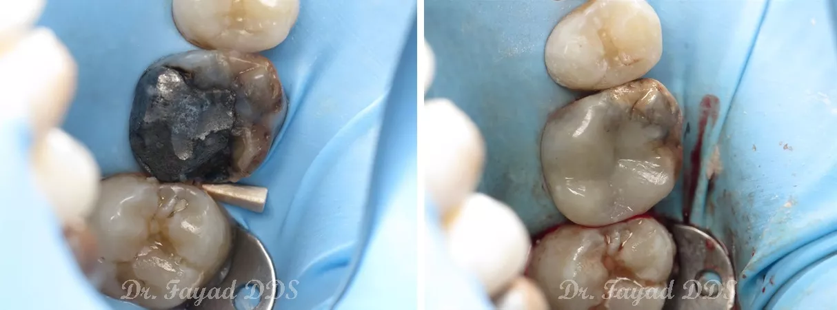 Dental before and after photo