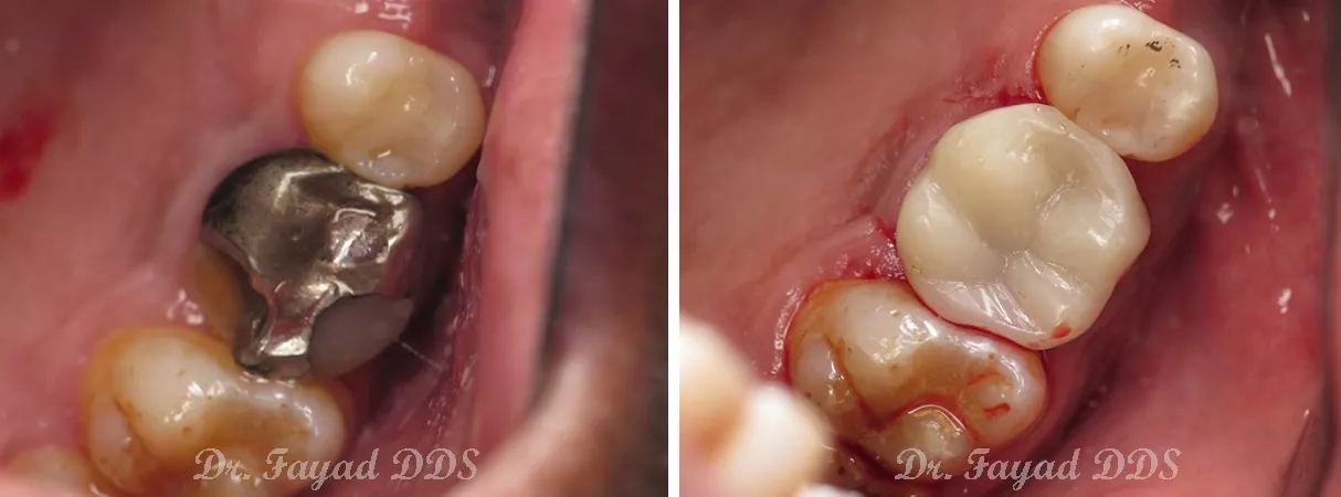 Dental before and after photo