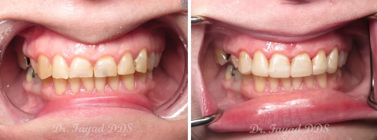 Dental before and after photo