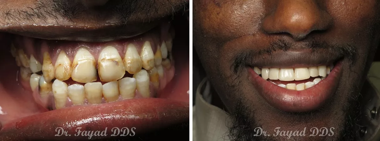 Dental before and after photo