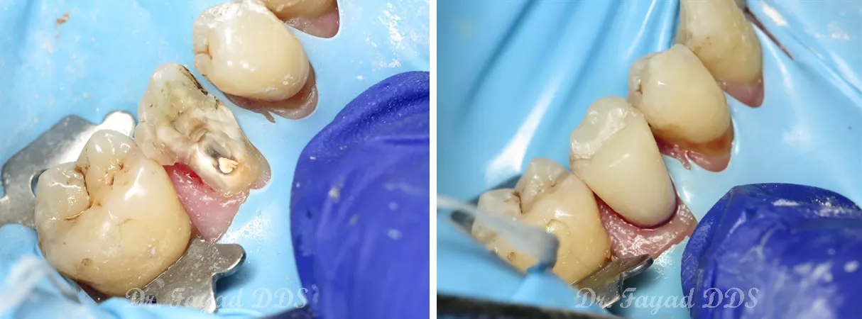 Dental before and after photo