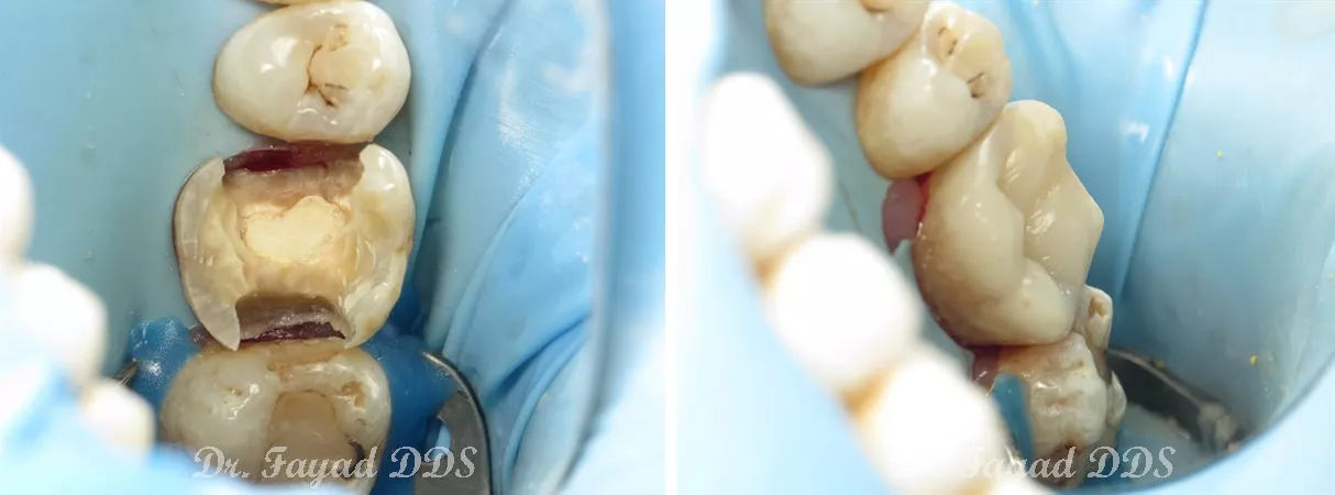 Dental before and after photo