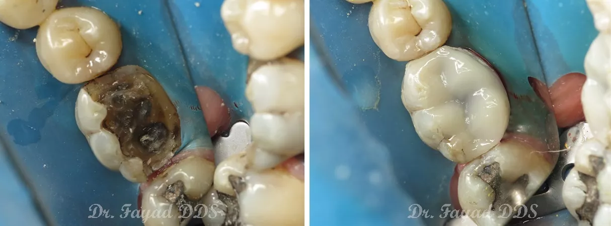 Dental before and after photo