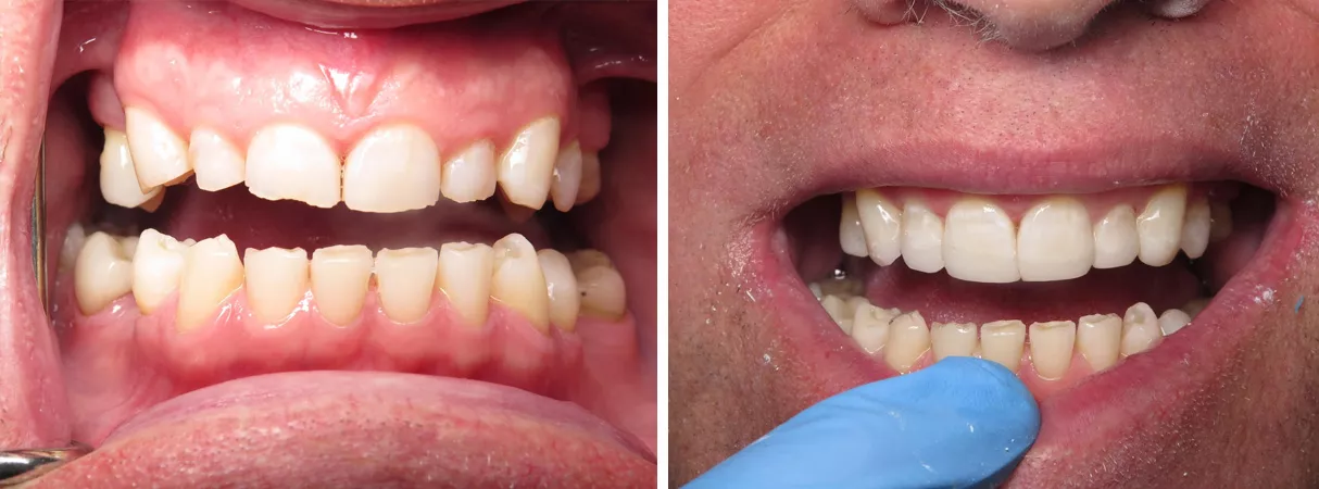 Dental before and after photo