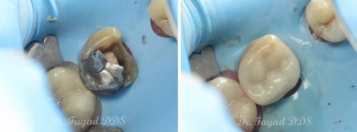 Dental before and after photo