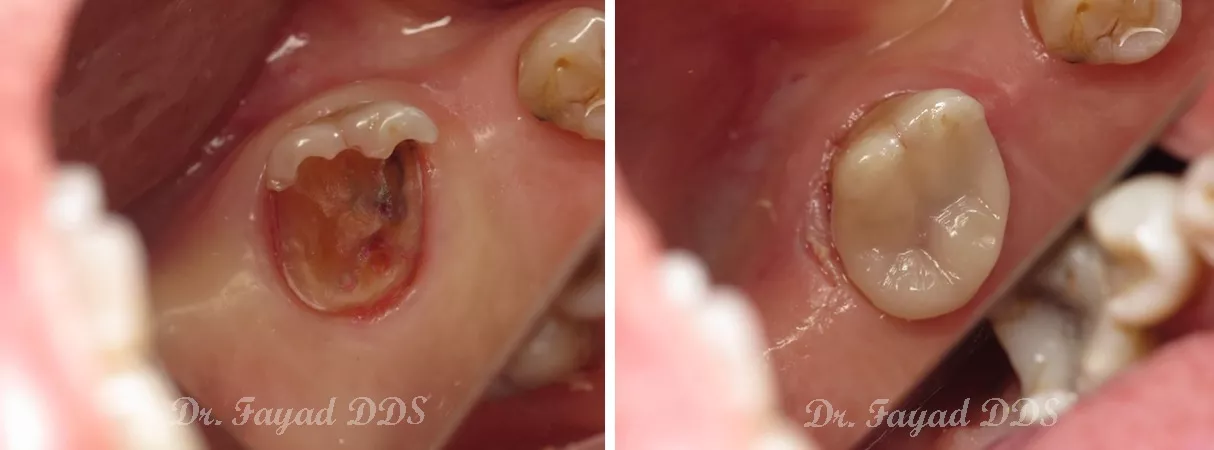 Dental before and after photo