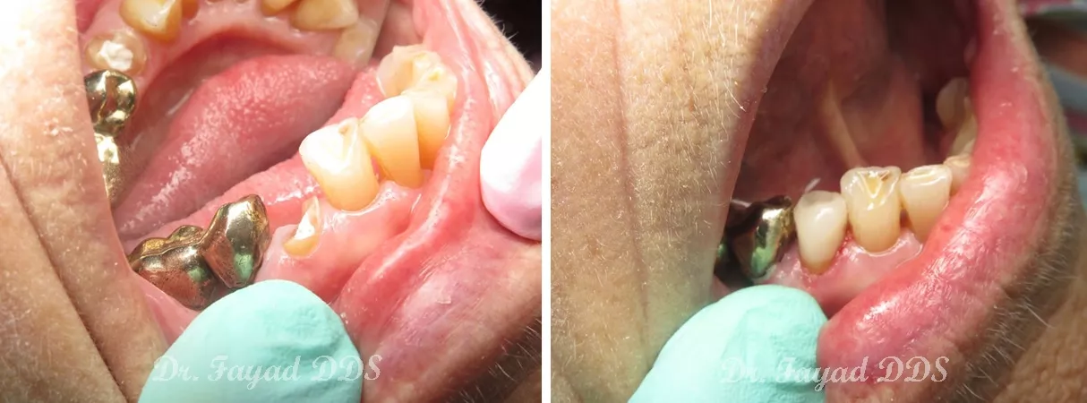 Dental before and after photo