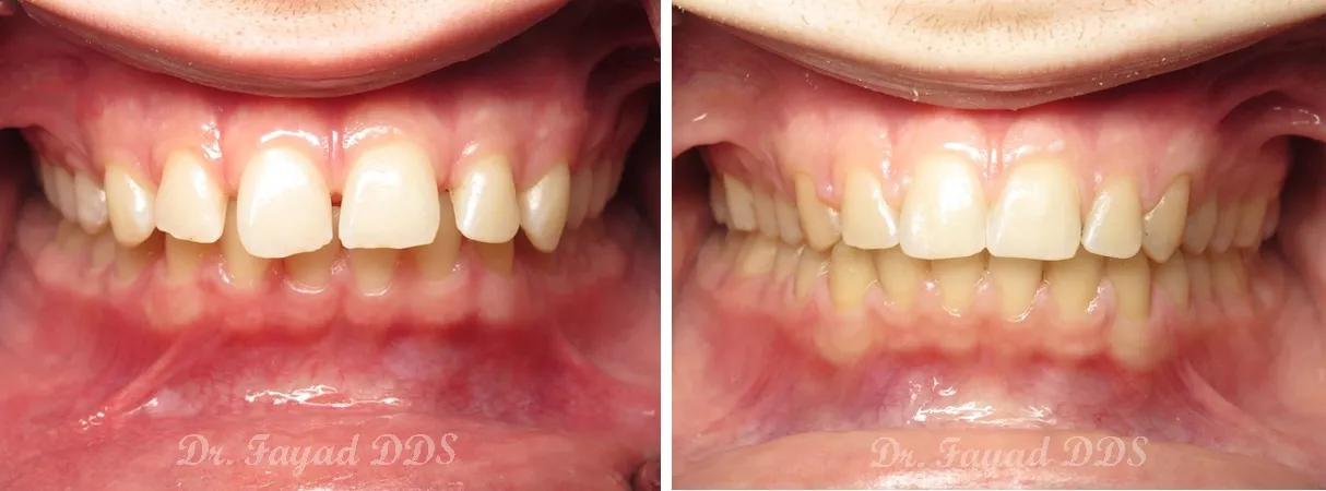 Dental before and after photo