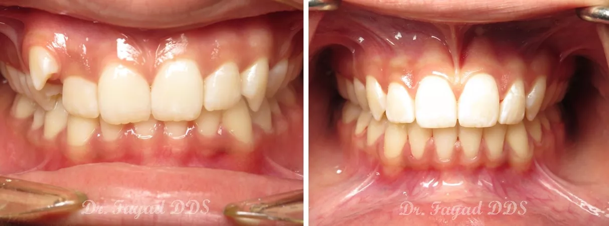 Dental before and after photo