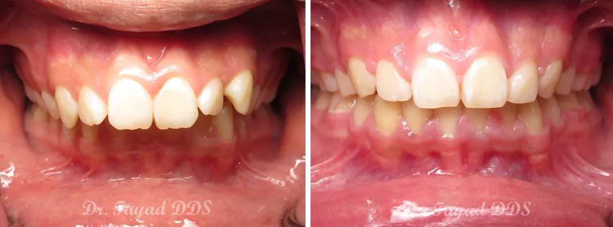 Dental before and after photo