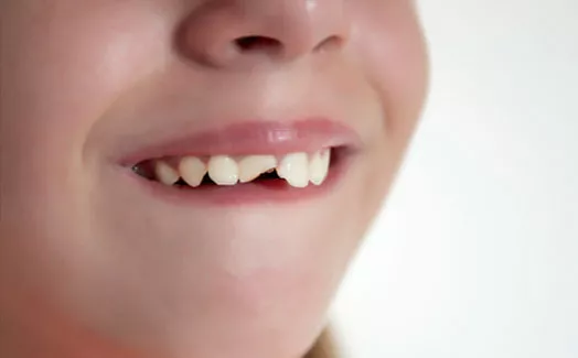 Young girl with cracked tooth