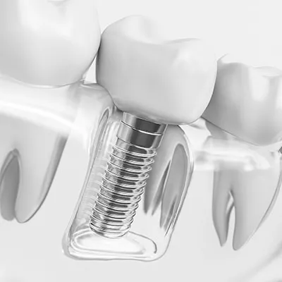 Model of dental implant